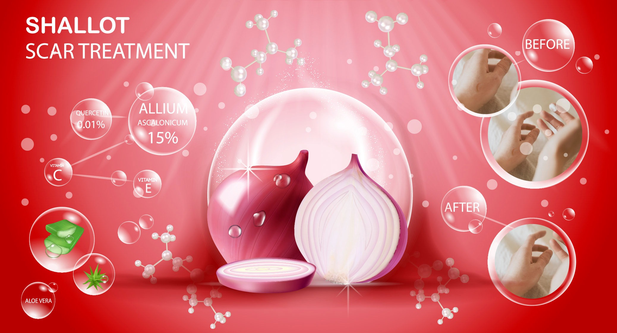 Shallot Extract for Scar Treatment
